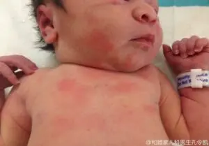 新生兒 - 解救0-1歲baby的常見皮膚狀況 - 圖 4
