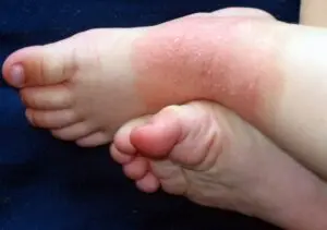新生兒 - 解救0-1歲baby的常見皮膚狀況 - 圖 7
