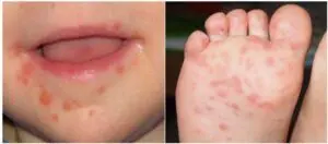新生兒 - 解救0-1歲baby的常見皮膚狀況 - 圖 6