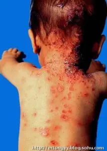 新生兒 - 解救0-1歲baby的常見皮膚狀況 - 圖 5